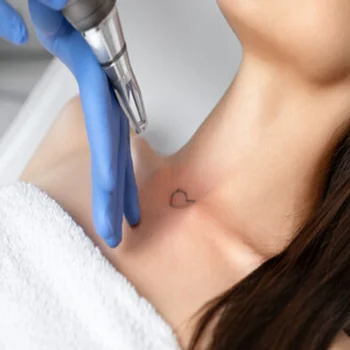 Laser Tattoo Removal Miami Beach